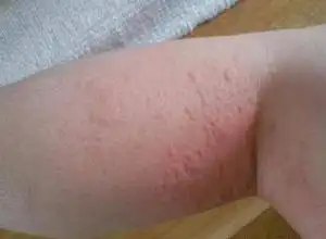 如果长时间生活在甲醛浓度超标的环境下,就会形成过敏性皮炎,红疹等